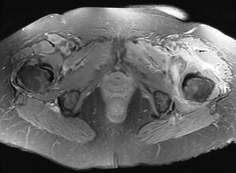 Figure 1 for case Psoas avulsion